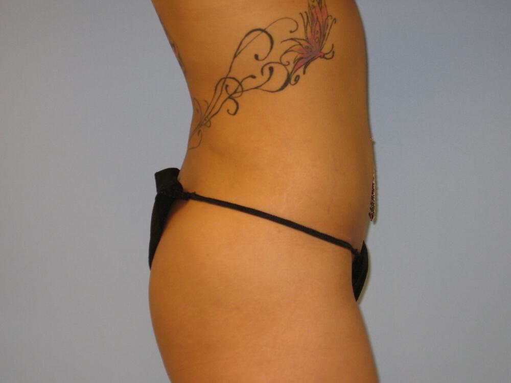 Liposuction Before & After Image