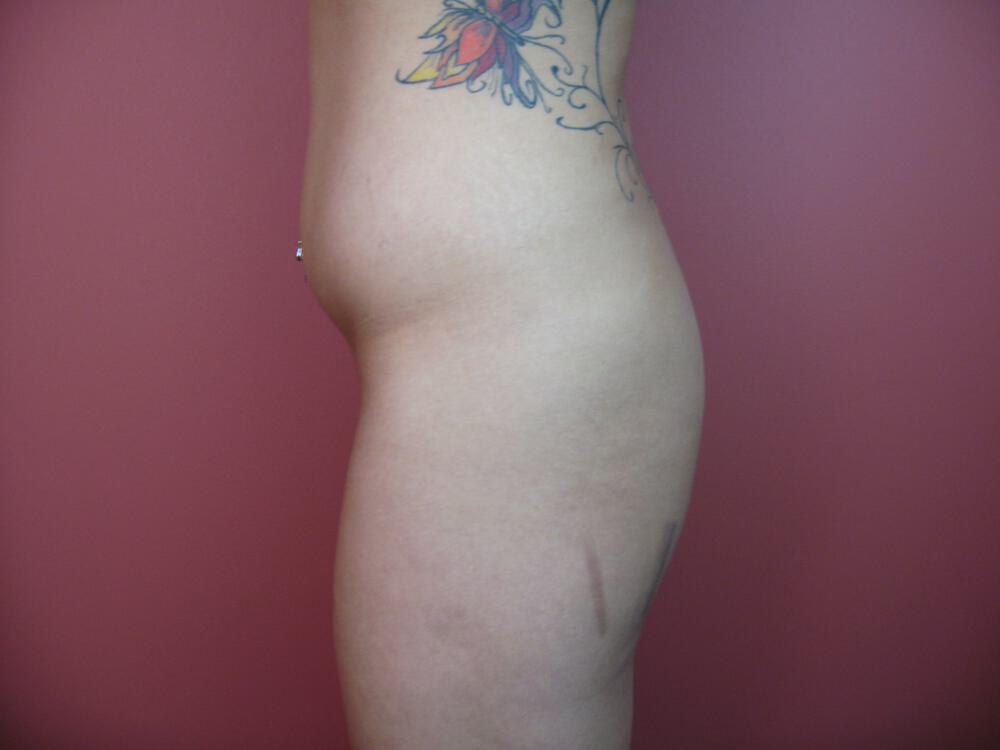 Liposuction Before & After Image