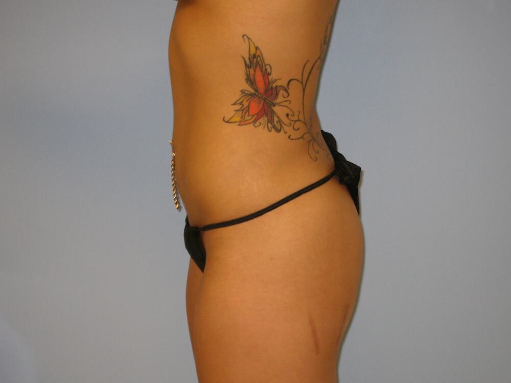 Liposuction Before & After Image