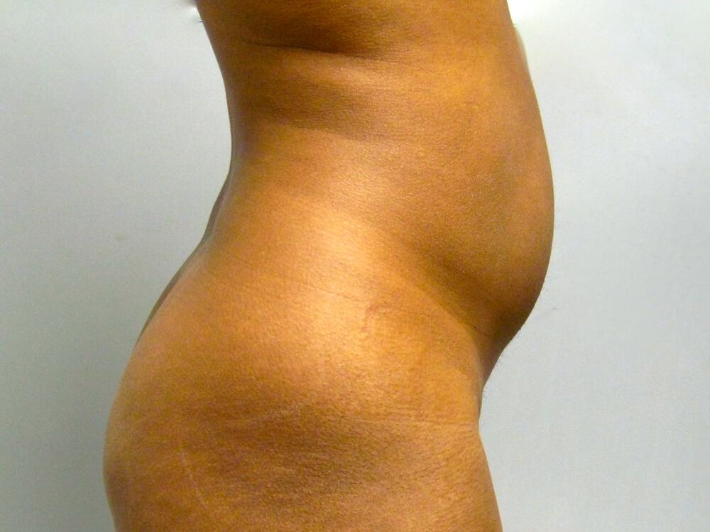 Liposuction Before & After Image