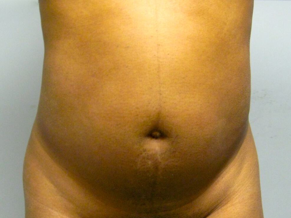 Liposuction Before & After Image