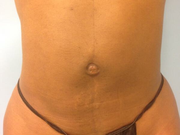 Liposuction Before & After Image