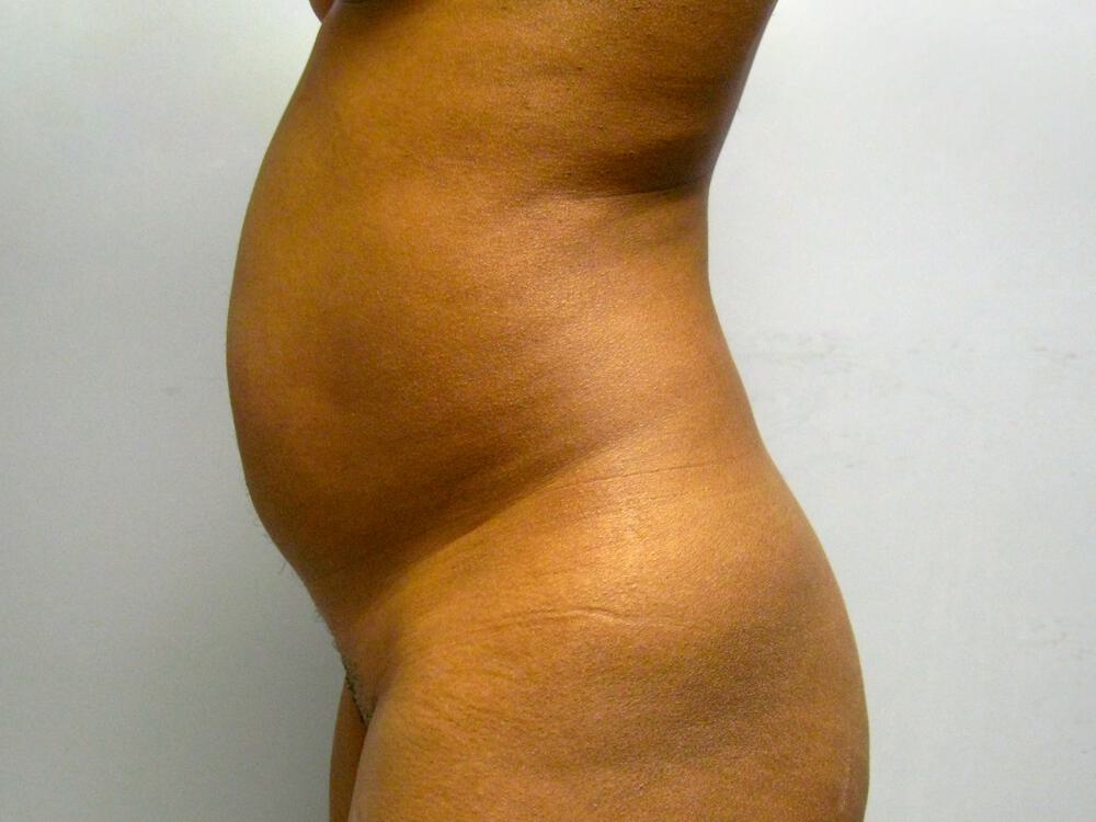 Liposuction Before & After Image