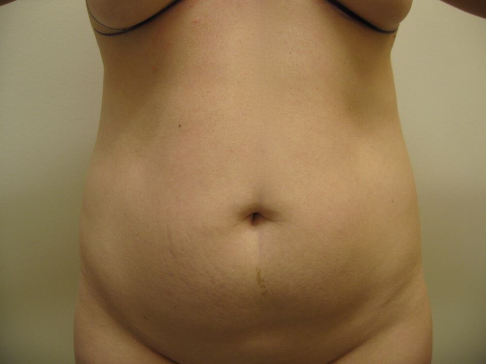 Liposuction Before & After Image