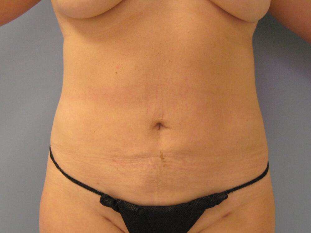 Liposuction Before & After Image