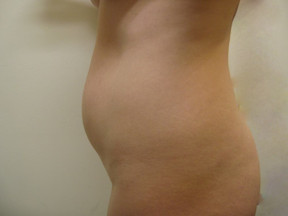 Liposuction Before & After Image