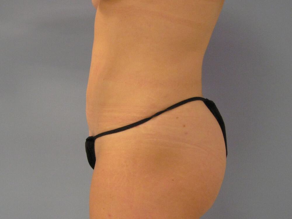 Liposuction Before & After Image