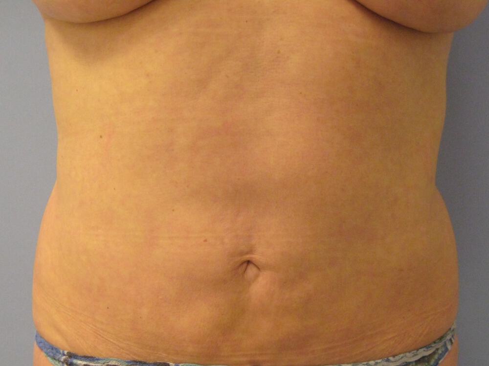Liposuction Before & After Image