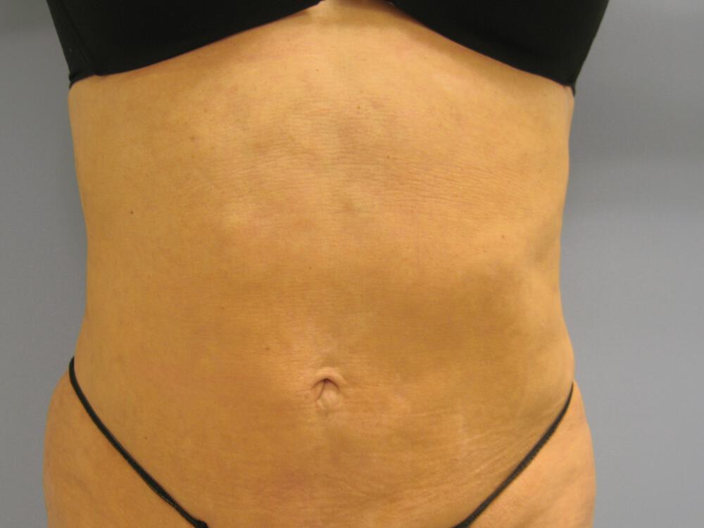 Liposuction Before & After Image