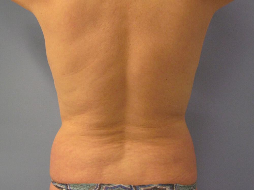 Liposuction Before & After Image