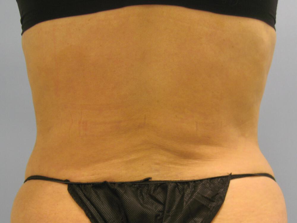 Liposuction Before & After Image