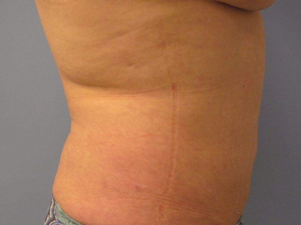 Liposuction Before & After Image