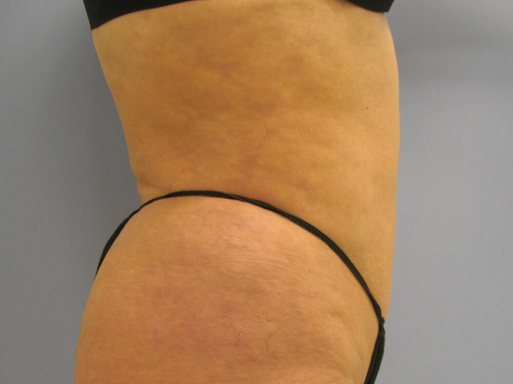 Liposuction Before & After Image