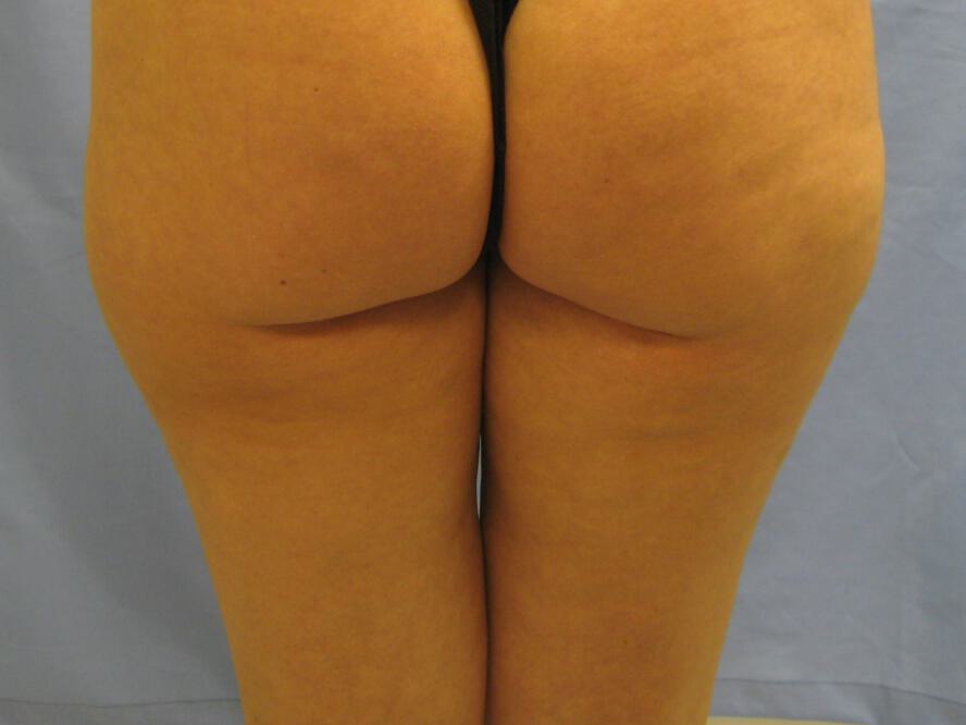 Liposuction Before & After Image