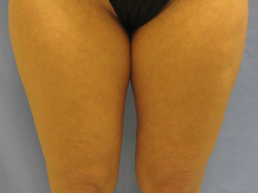Liposuction Before & After Image