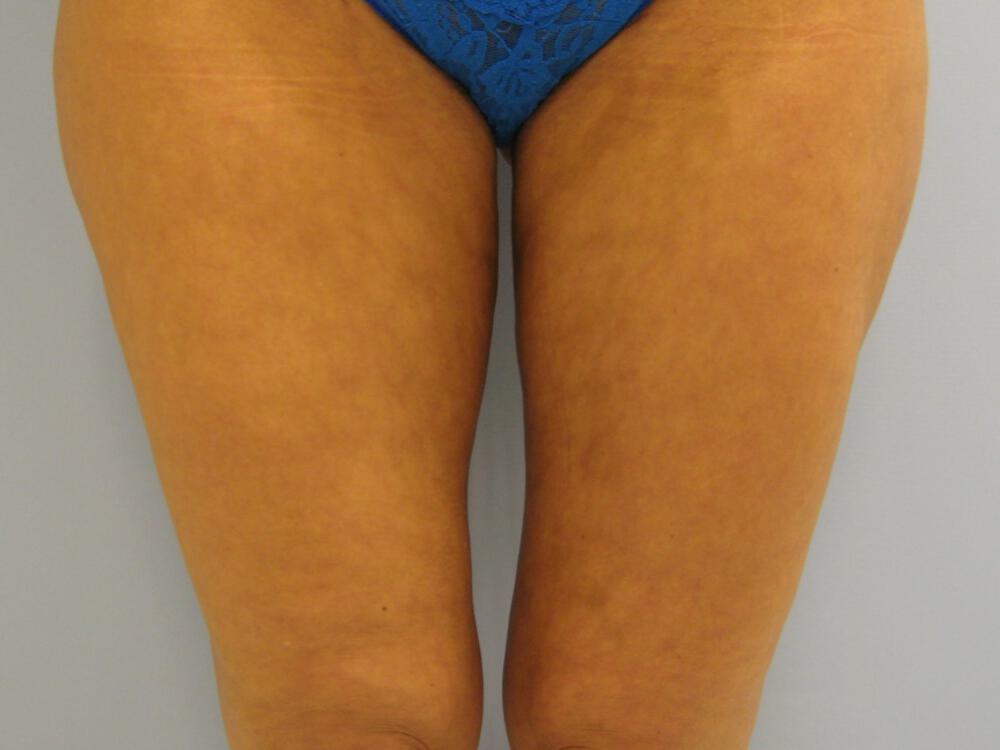 Liposuction Before & After Image