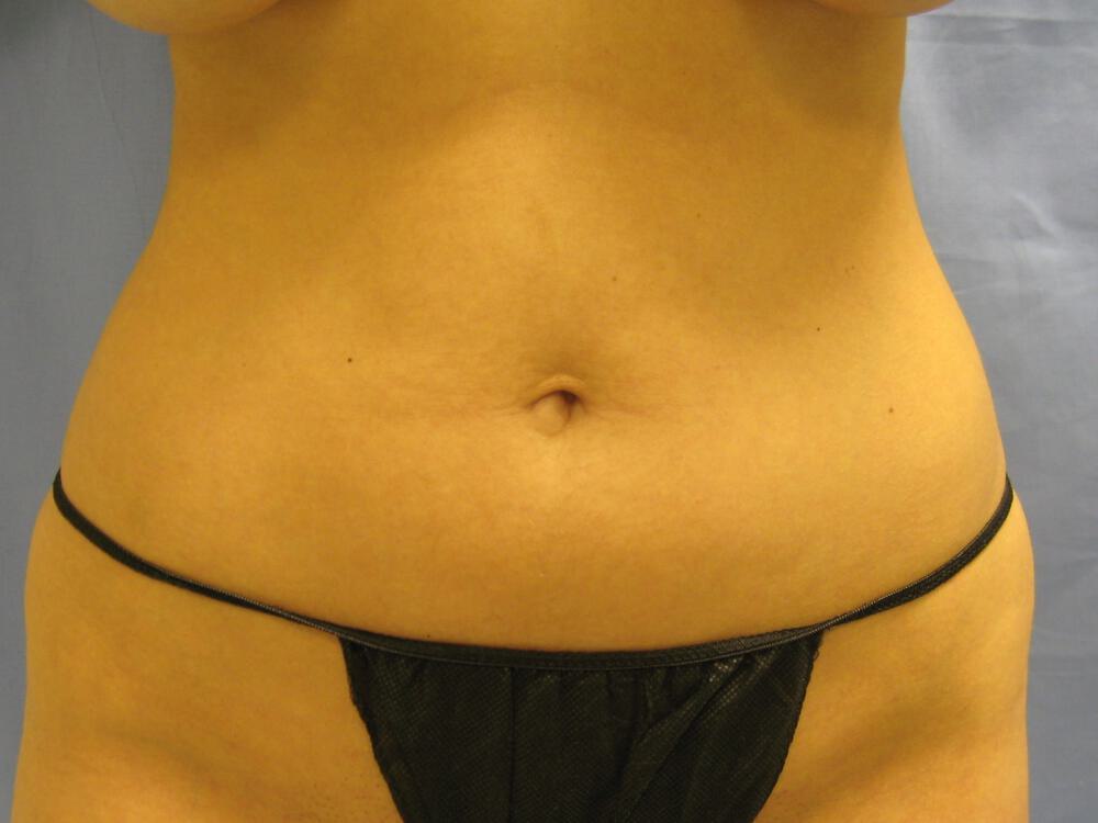 Liposuction Before & After Image
