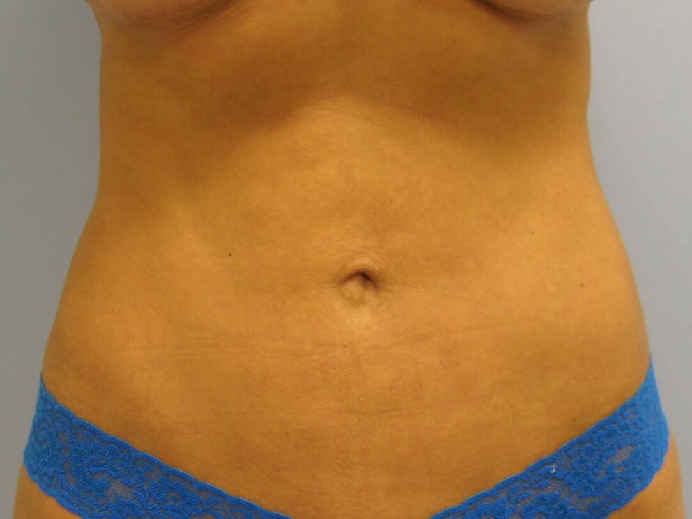 Liposuction Before & After Image