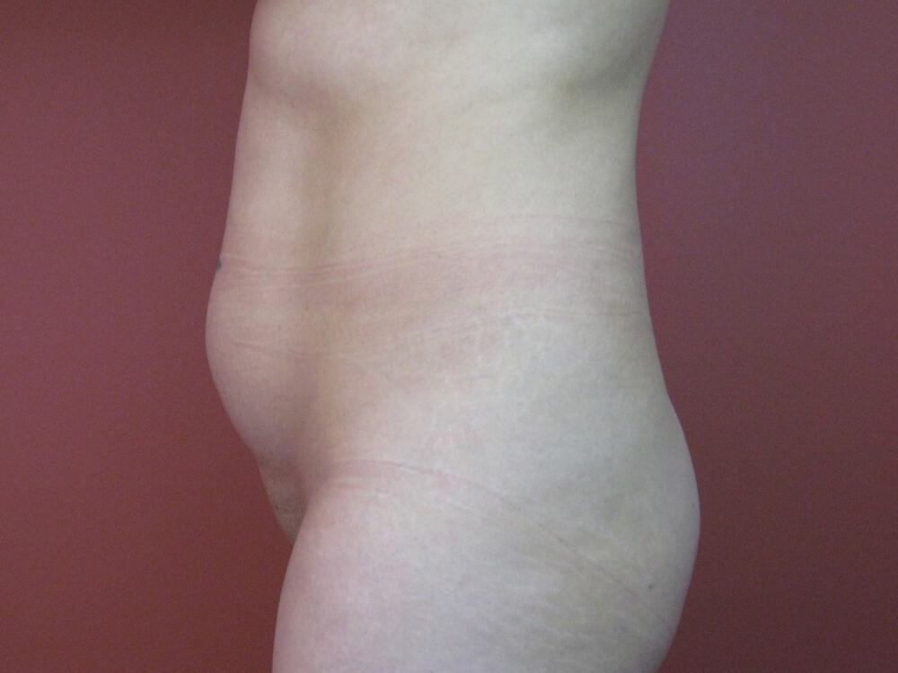 Liposuction Before & After Image