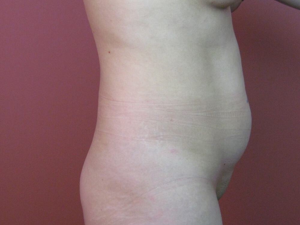 Liposuction Before & After Image