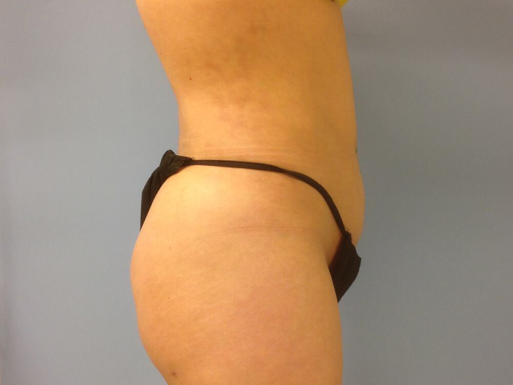 Liposuction Before & After Image