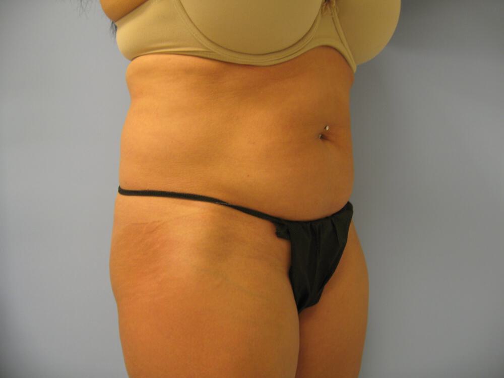 Liposuction Before & After Image