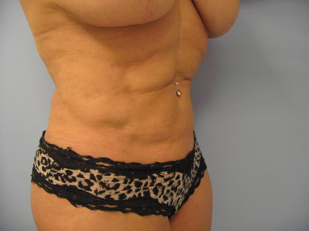 Liposuction Before & After Image