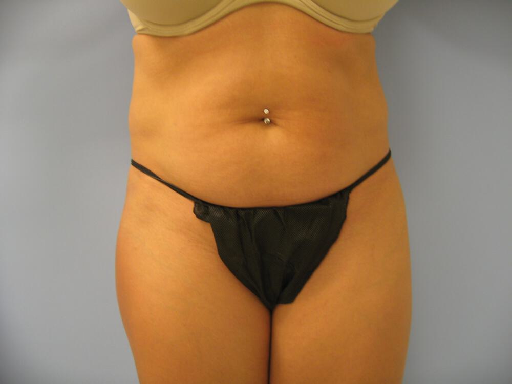 Liposuction Before & After Image