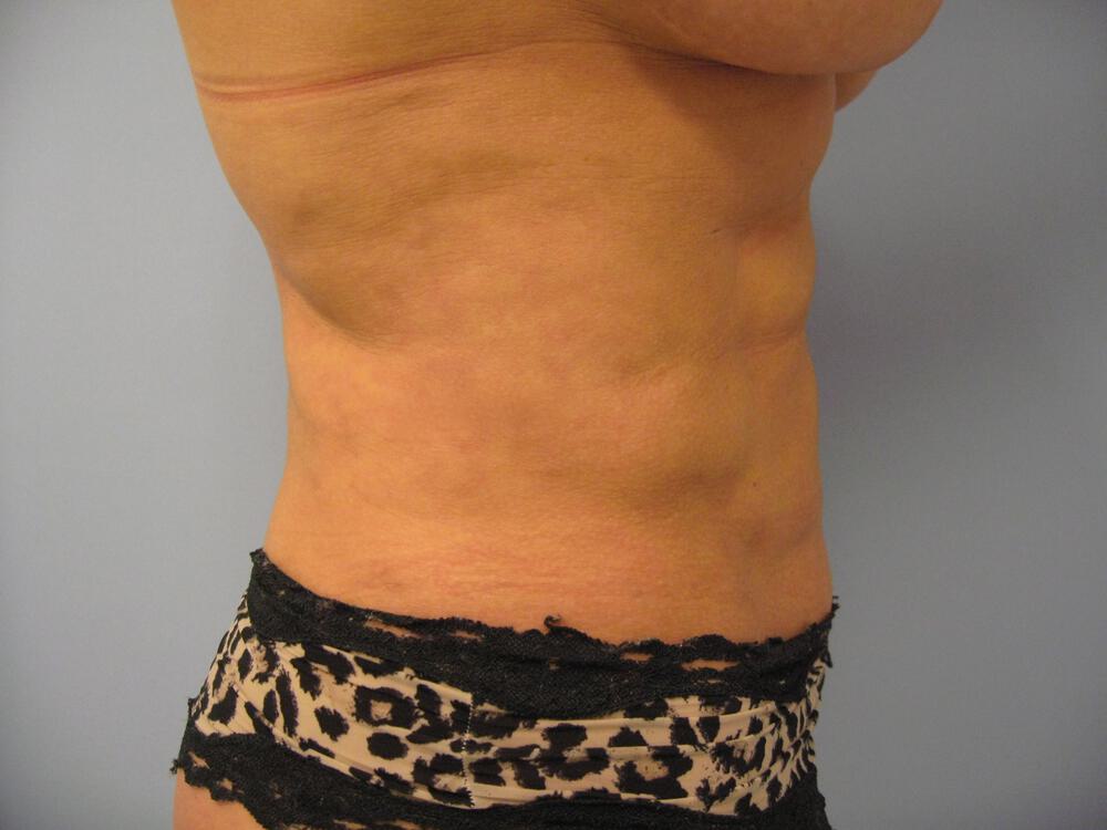 Liposuction Before & After Image