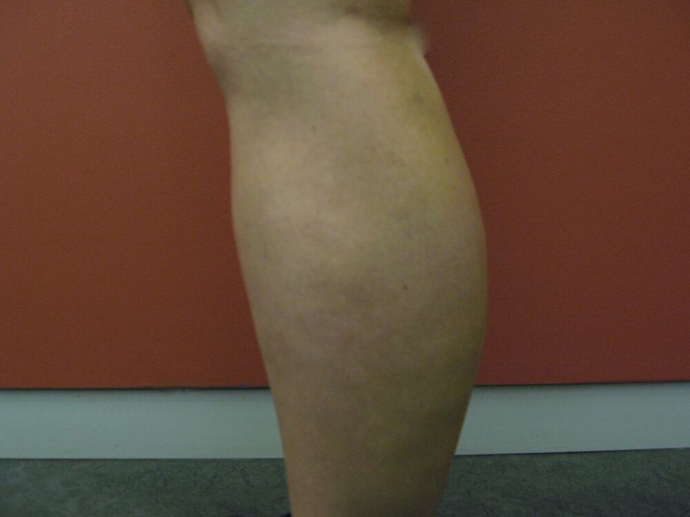 Liposuction Before & After Image