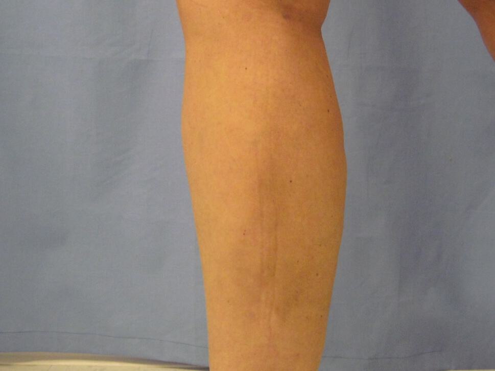 Liposuction Before & After Image
