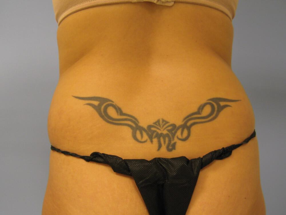 Liposuction Before & After Image