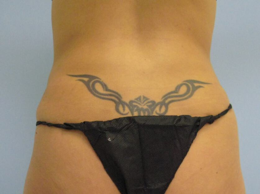 Liposuction Before & After Image
