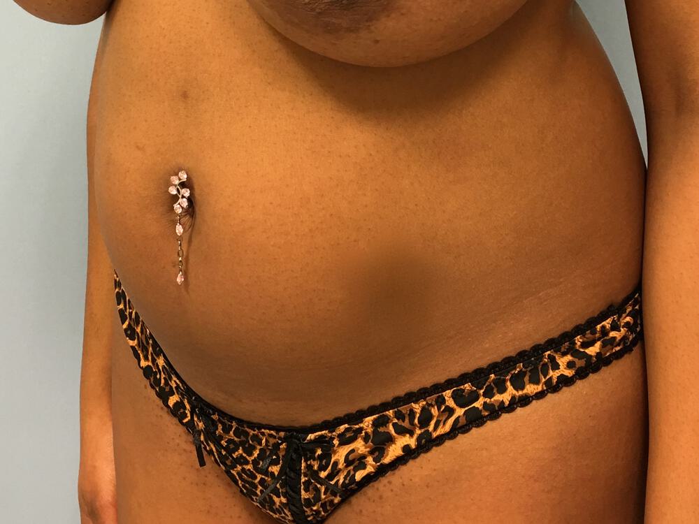 Liposuction Before & After Image