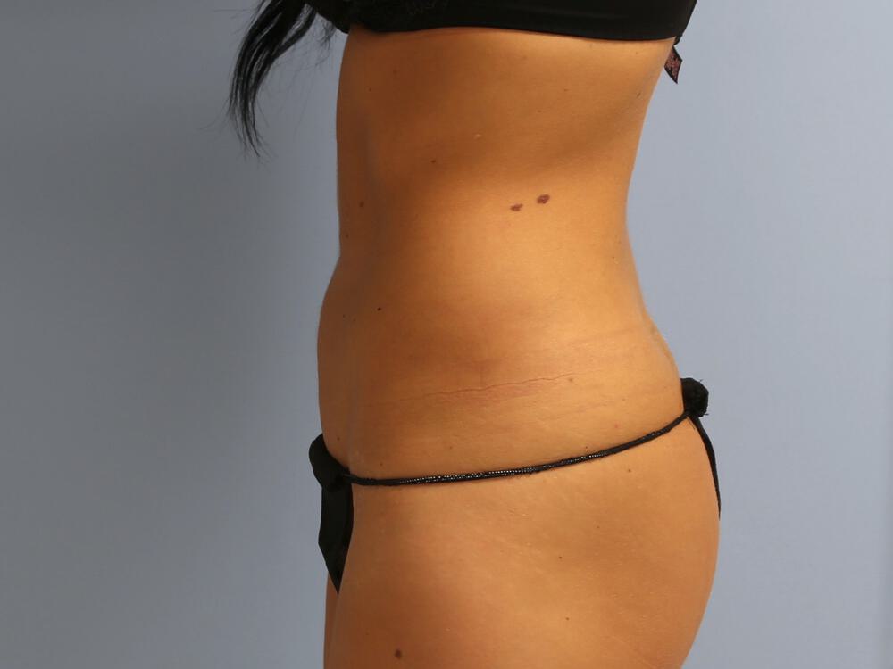 Liposuction Before & After Image