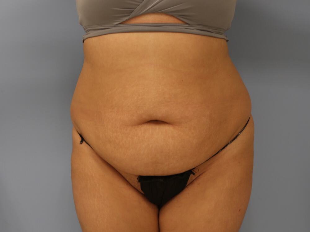 Liposuction Before & After Image