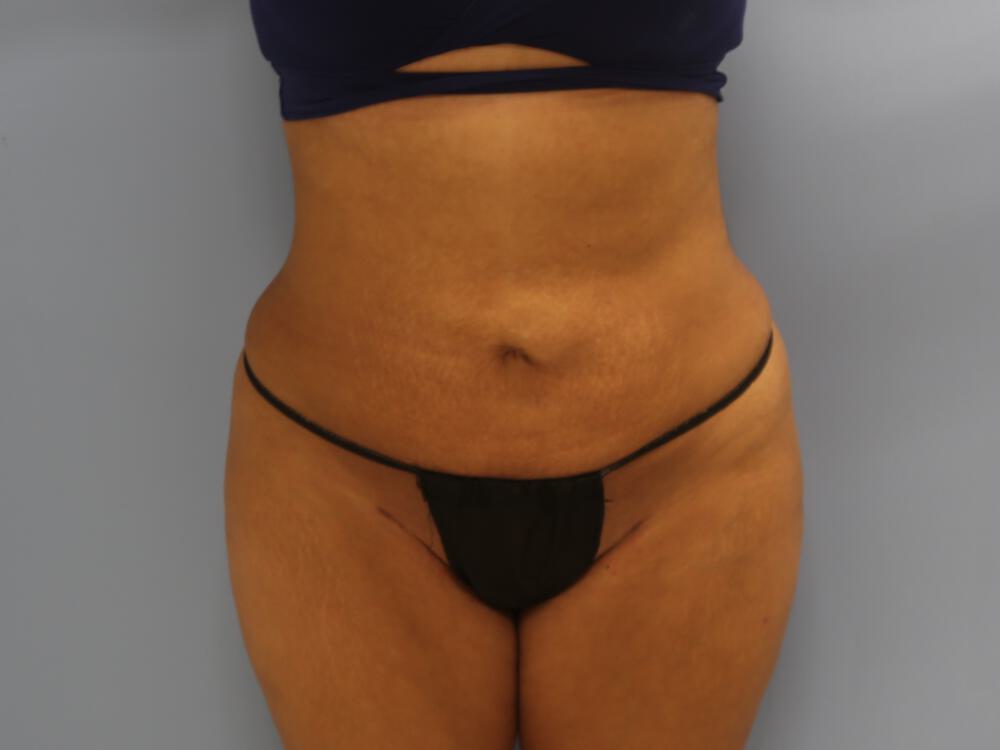 Liposuction Before & After Image