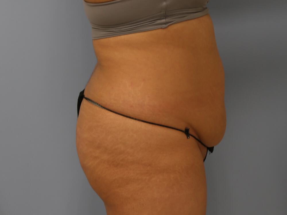 Liposuction Before & After Image