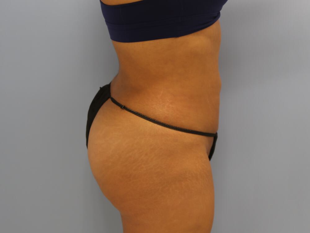 Liposuction Before & After Image