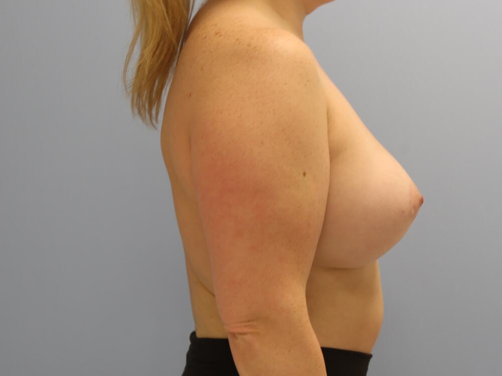 Liposuction Before & After Image