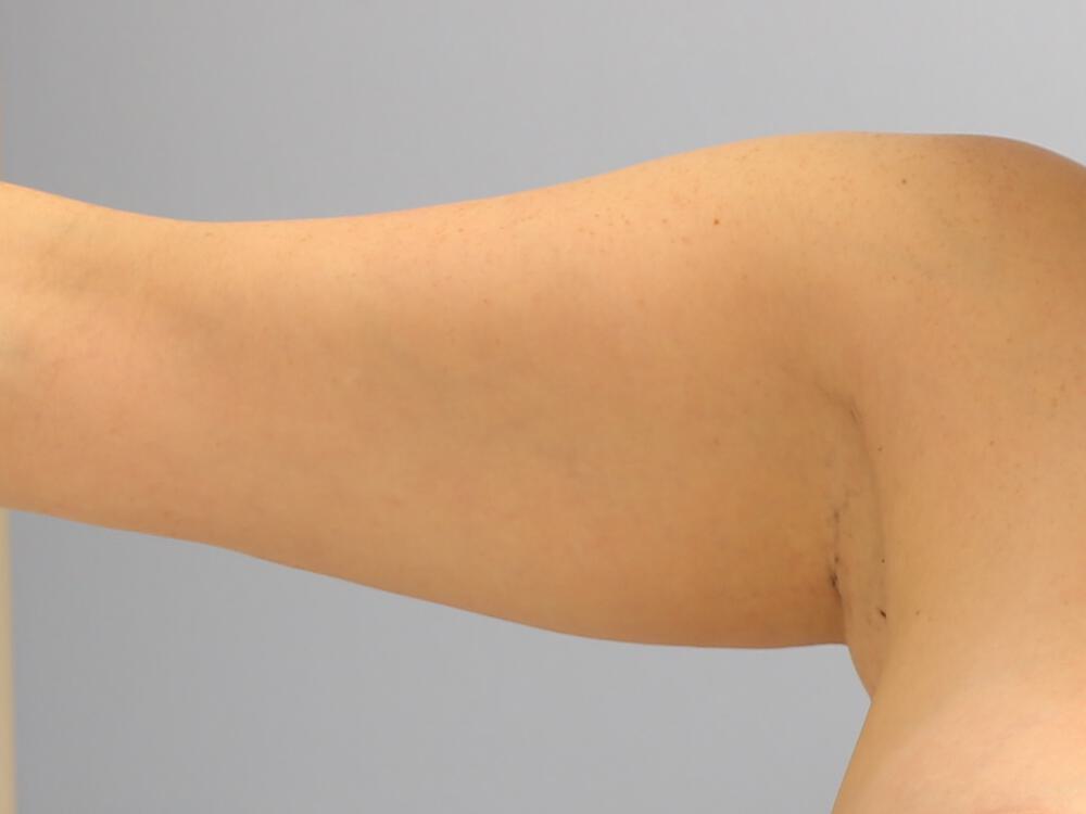 Liposuction Before & After Image