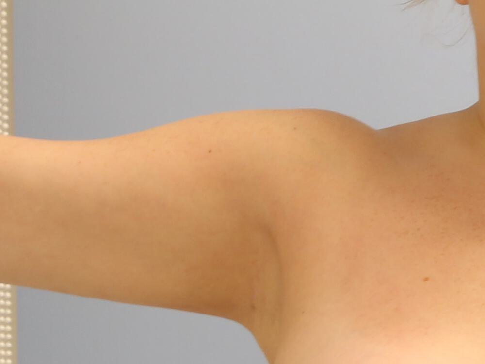 Liposuction Before & After Image