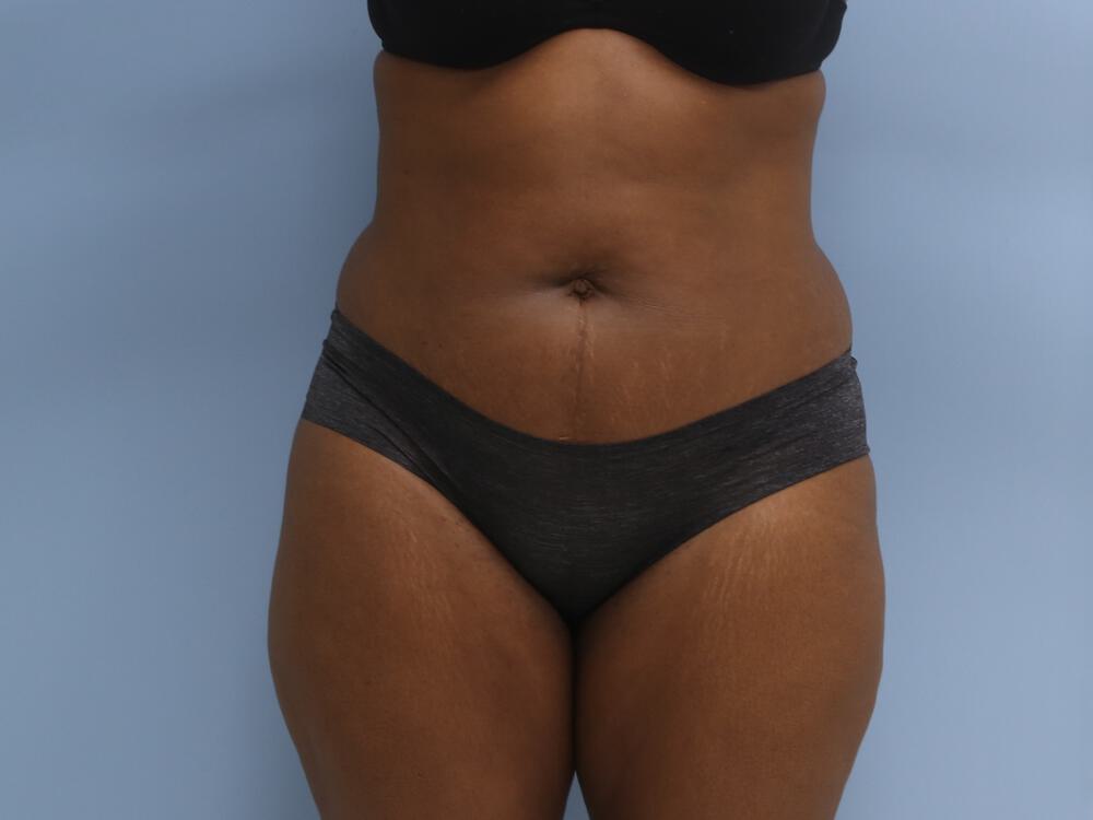 Liposuction Before & After Image