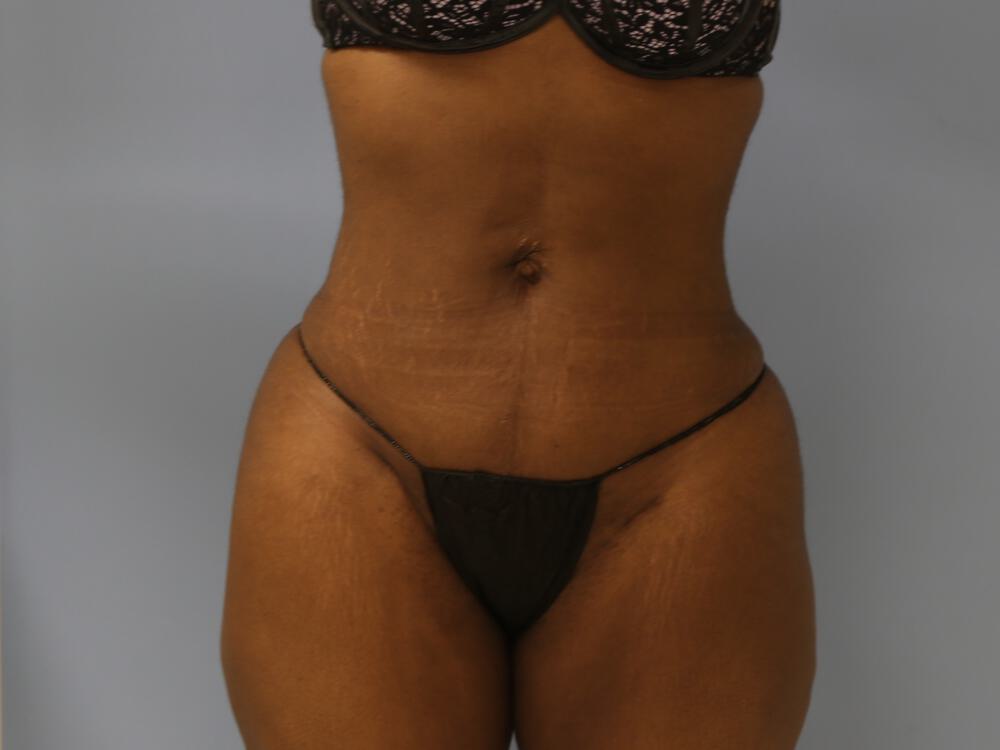 Liposuction Before & After Image