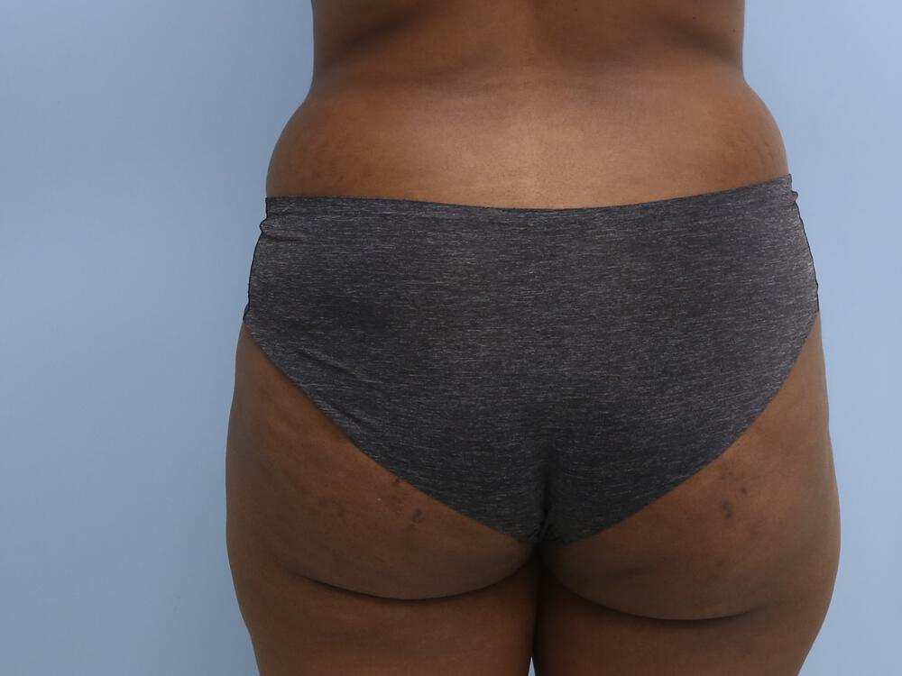 Liposuction Before & After Image
