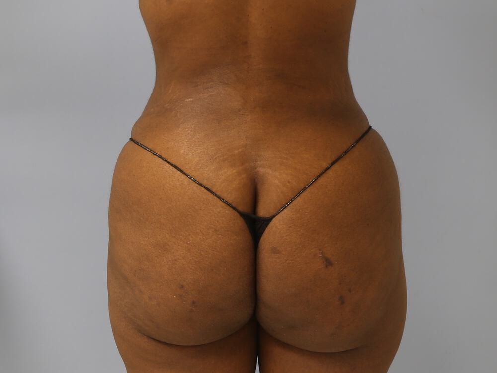 Liposuction Before & After Image