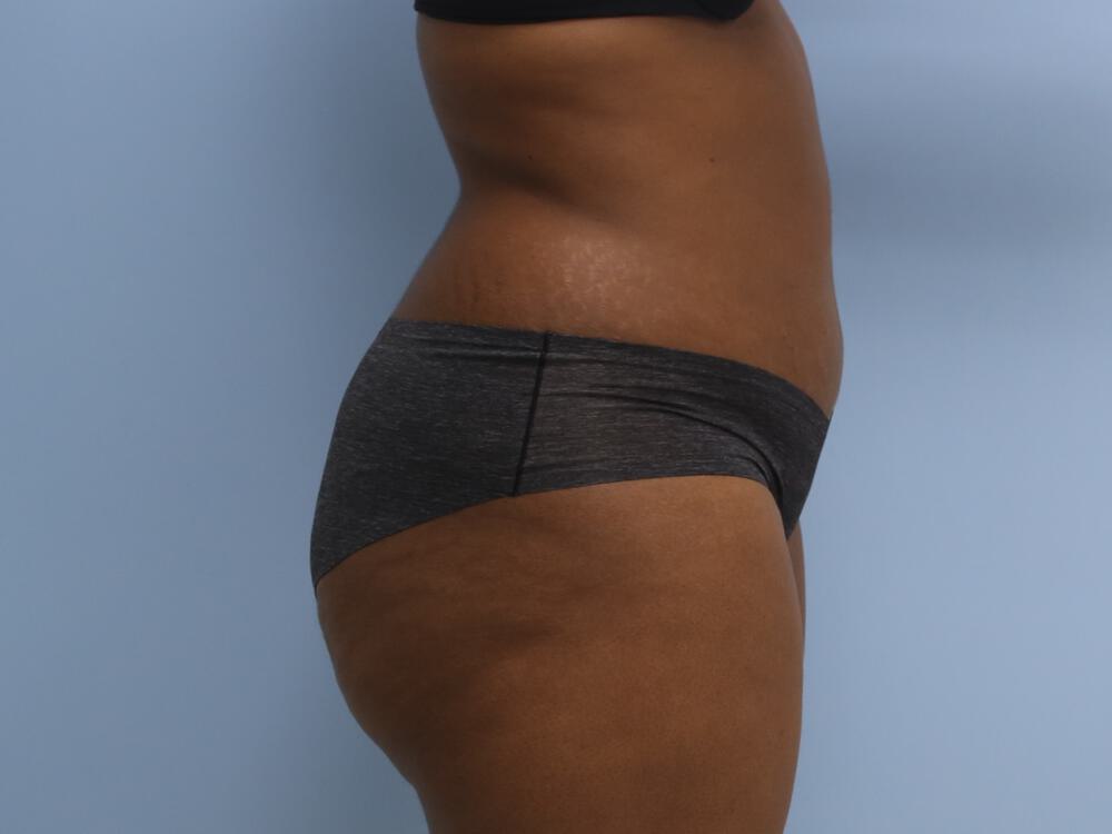 Liposuction Before & After Image