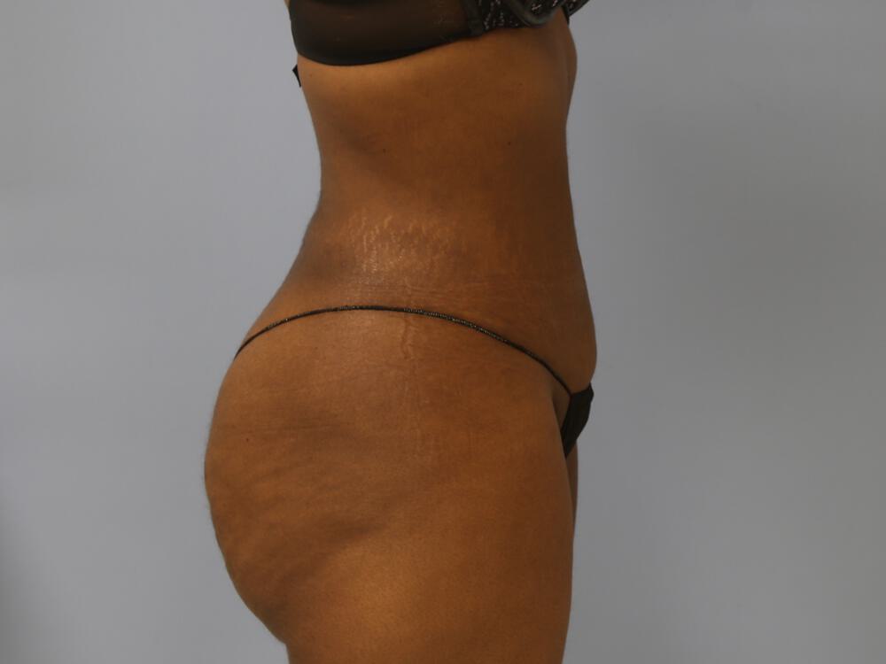 Liposuction Before & After Image