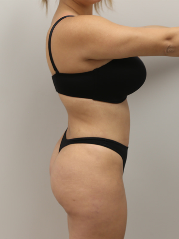 Liposuction Before & After Image