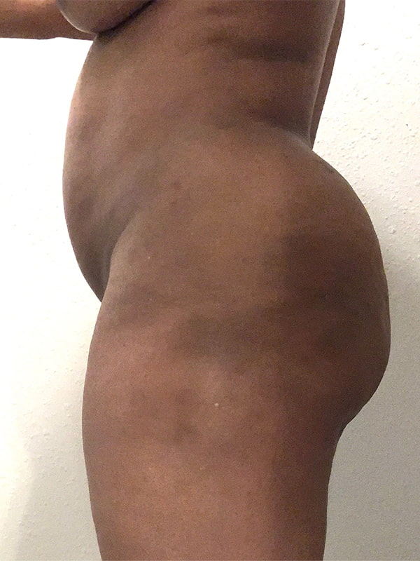 Liposuction Before & After Image